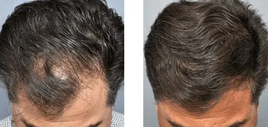 Discover the Best Hair Loss Treatments Near Me: Your Solution to Thinning Hair!